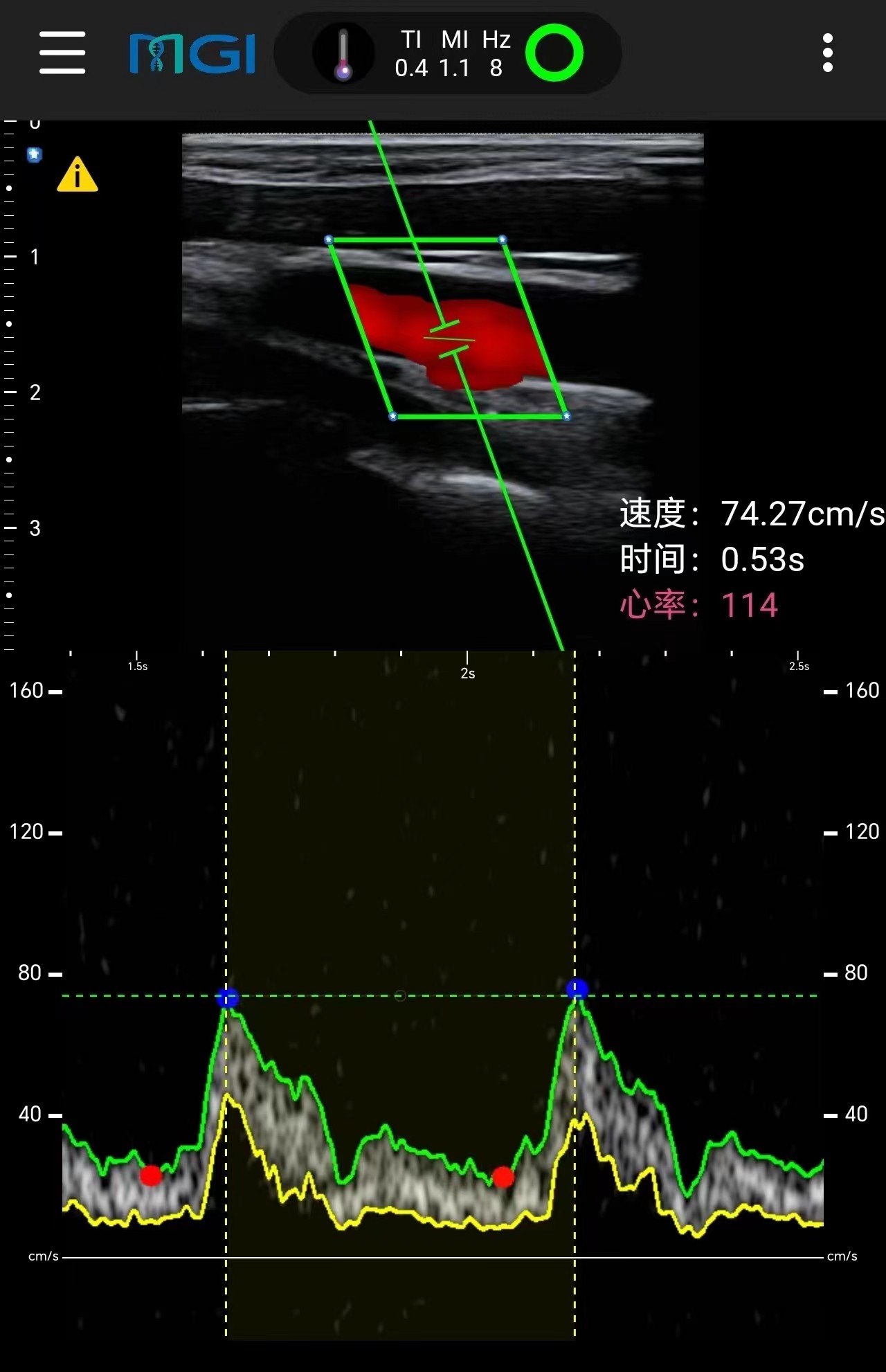 在珠峰顶实时获取的颈动脉超声扫查图像.jpg